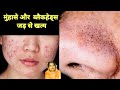 मुहांसों से बन गए हैं चेहरे पर Whitehead और Blackheads तो घर पर इन चीजों का करें इस्तेमाल Skin care