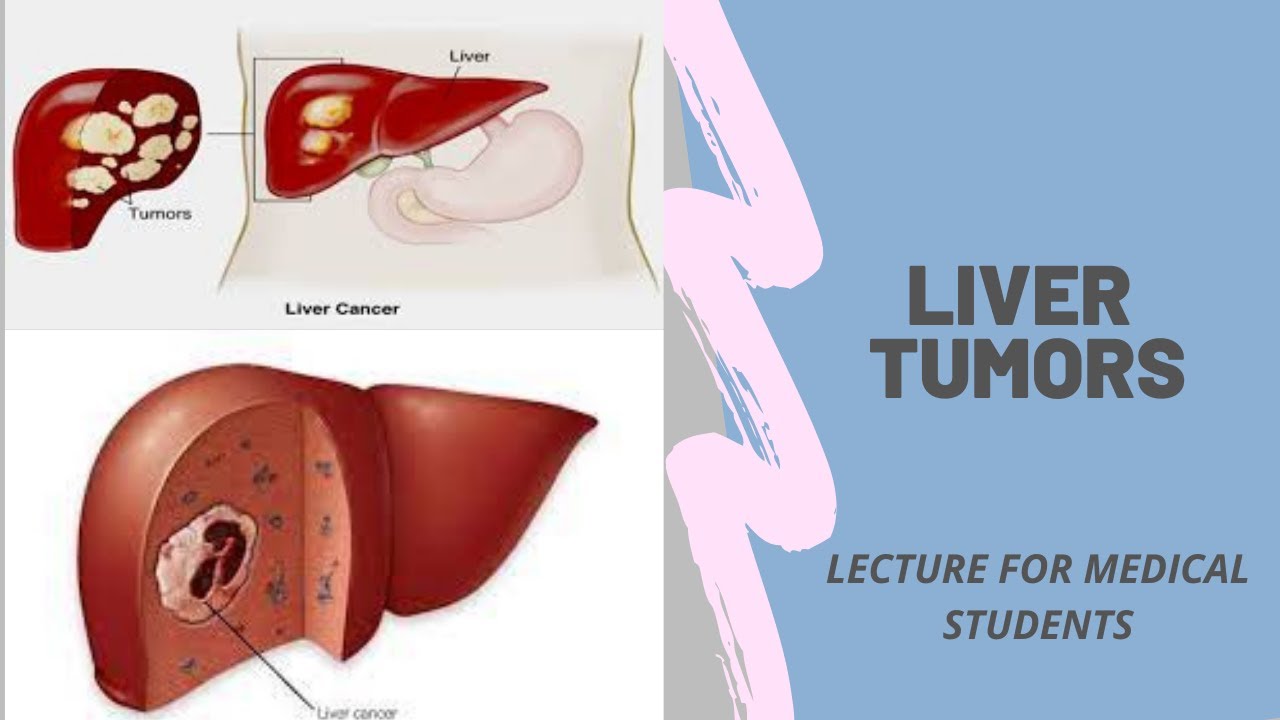 Liver tumors - Lecture for Medical Students  #mbbs #neet #usmle #fmge #neetpg