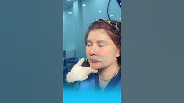 Độn Rãnh Cười-Trẻ Ra 10 tuổi