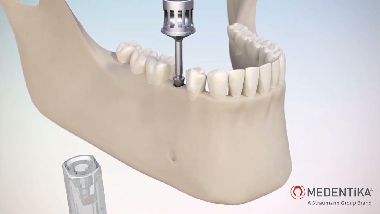 Упаковка имплантатов Medentika® - YouTube