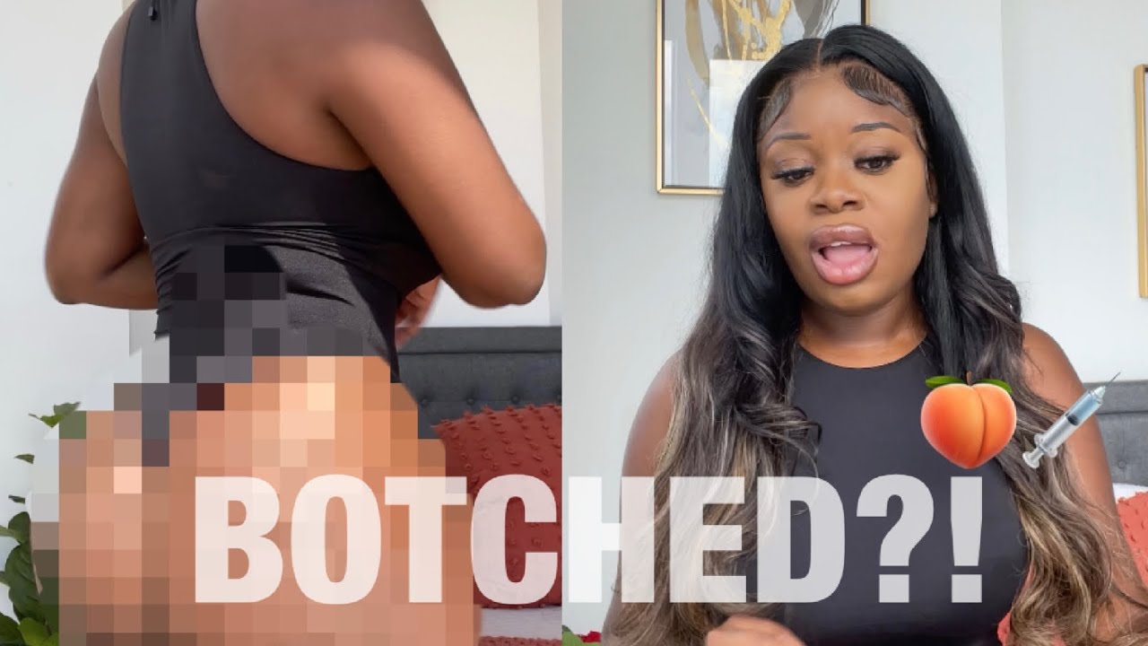 BBL 6 MONTH UPDATE.. BOTCHED? ROUND 2? WASTE OF MONEY? SPILLING ALL THE TEA  ON MY SURGERY!