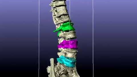 Lumbar L1, L3, L5 models segmented using ScanIP