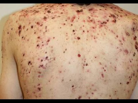 Steroid acne on back pictures