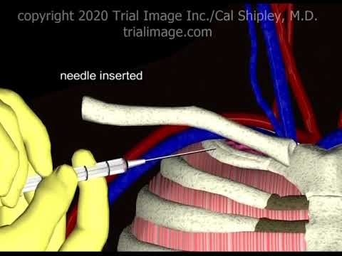 Subclavian Vein Access - Normovolemic Patient Animation by Cal Shipley, M.D.
