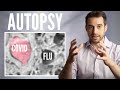 Coronavirus vs Flu vs Normal Lungs | Autopsy Comparison