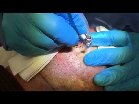 Neograft Hair Transplant Austin TX by Beleza Medspa