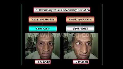 Primary versus secondary eye deviation