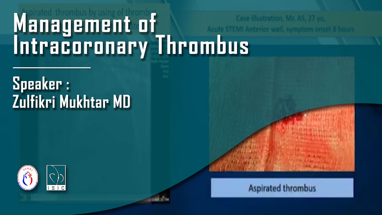 Management of Intracoronary Thrombus