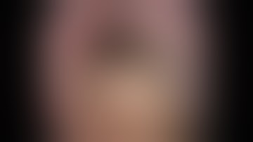 18.120GS Endoscopic Submucosal  Myotomy of Esophageal Epiphrenic Diverticula: Is It Sufficient?