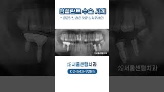 임플란트 치료 과정