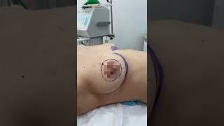 Breast augmentation at Agapit Medical Center