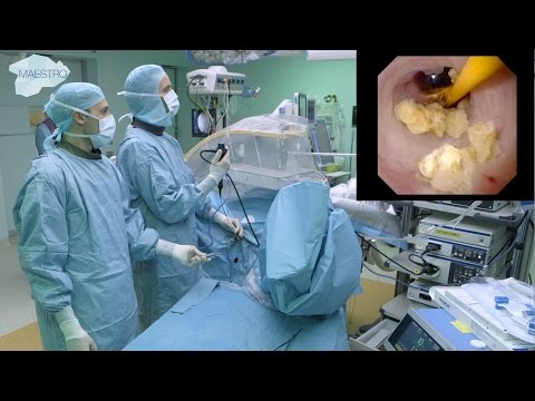 Video: Nyresten - Ernæring Og Diæt Til Urolithiasis