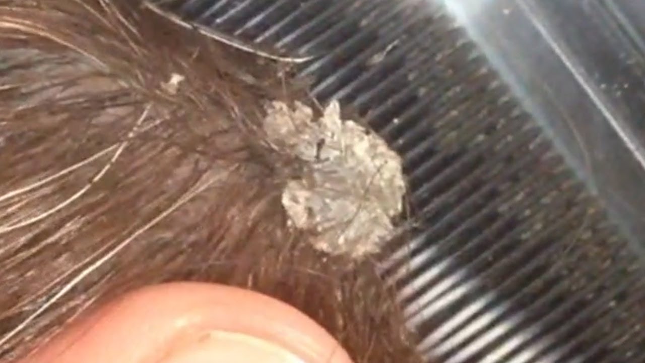 Scratching Huge Flakes / Big dandruff Flake /Big Scalp Flakes Removal