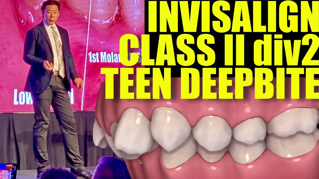 Invisalign Teen Class II div2 Deepbite Non Extraction 【過蓋咬合】