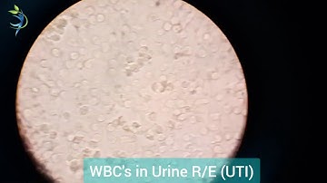 Urine Analysis | Urine Routine Examination | Microscopic Examination | by YouTube Healthcare