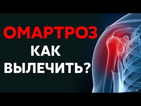 Артроз плечевого сустава - как вылечить?