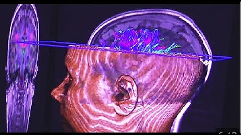 ¿El escáner cerebral muestra esquizofrenia?