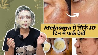 How to cure Hyperpigmentation naturally | Jhaiya Melasma Home Remedy | Upasana ki Duniya