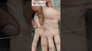 Troubled by a tough scar after trigger finger operation? #triggerfinger