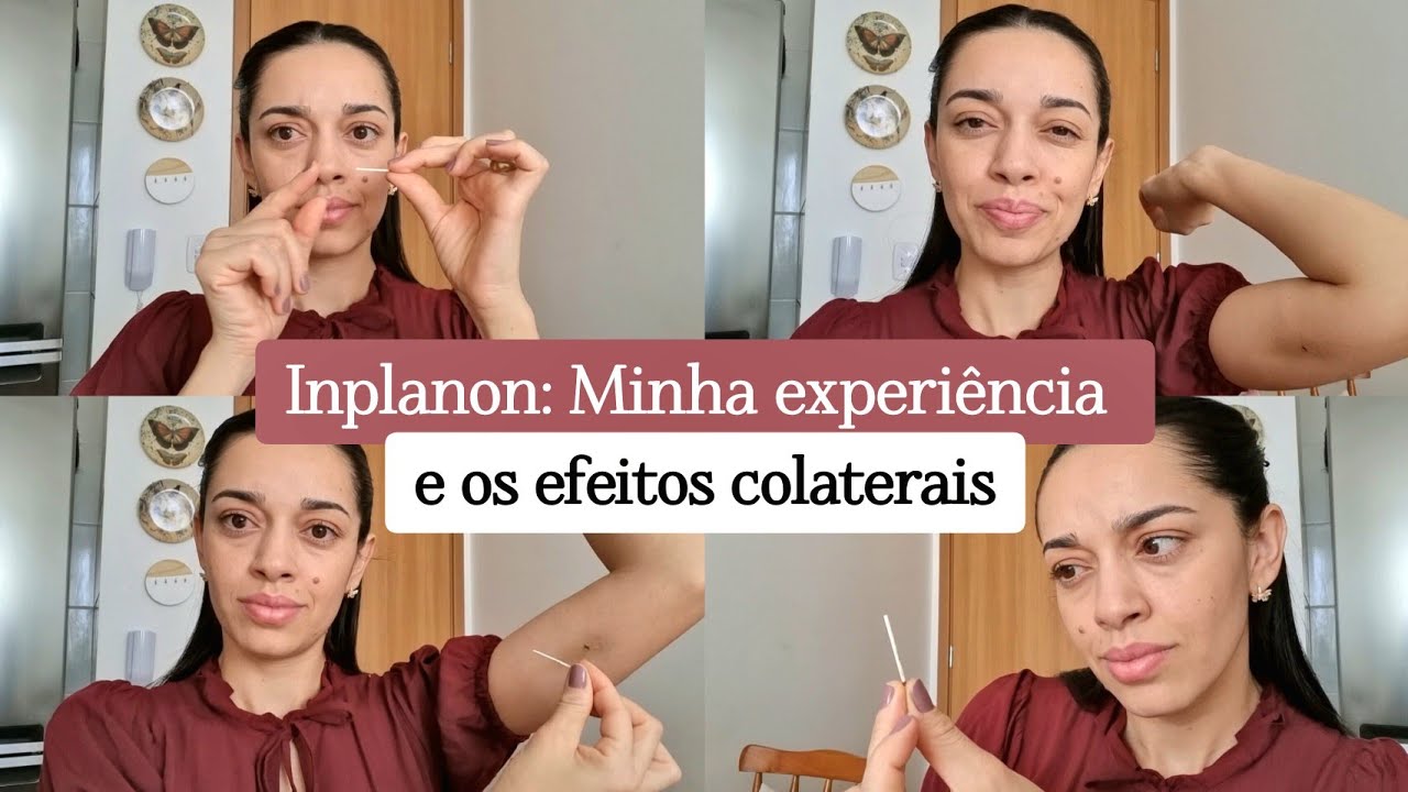 RETIREI O IMPLANON depois de 2 anos e meio - Minha experiência com o ...
