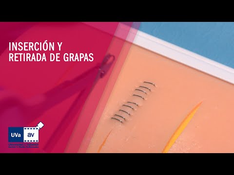 Vídeo: Grapas Quirúrgicas: Cómo Se Colocan, Quitan Y Ayudan A Sanar