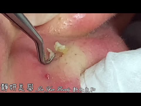 全臉閉鎖粉刺(Full face atresia acne)-Taiwan New Taipei City-大台北清粉刺最乾淨