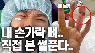 웰시코기 강아지 싸움 말리다 개물림 사고로 3주째 입원한 견주.. 병원 고인물이 되어 가는데..