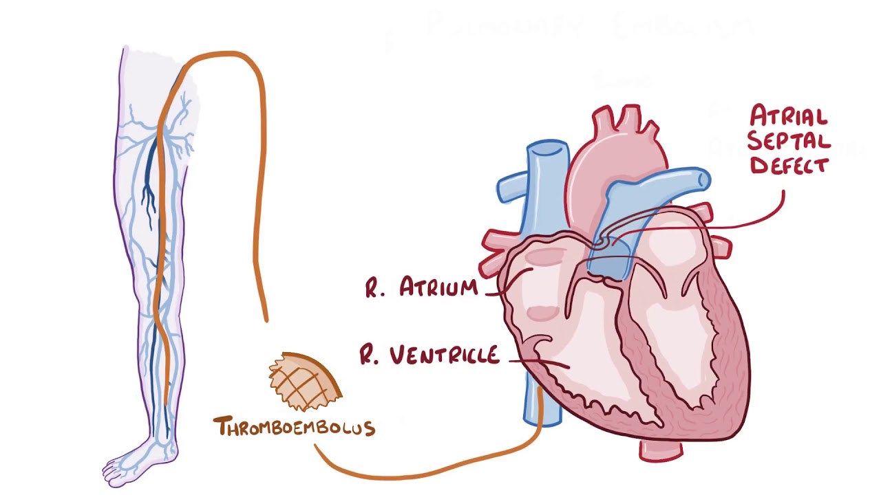 Pulmonary Embolisms   causes, symptoms, diagnosis, treatment, pathology