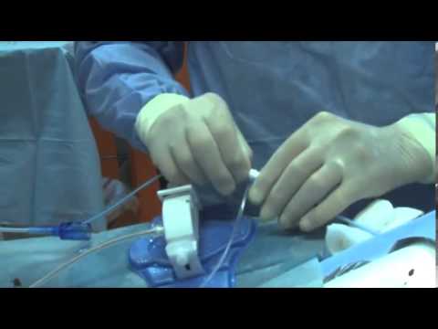 Video: Cateterismo Cardiaco E Ablazione: Complicanze, Rischi, Recupero