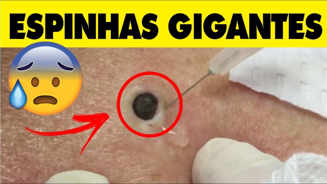 😱😱 TIRANDO CRAVOS E ESPINHAS, EXTRAÇÃO DE CRAVOS (2020) - YouTube