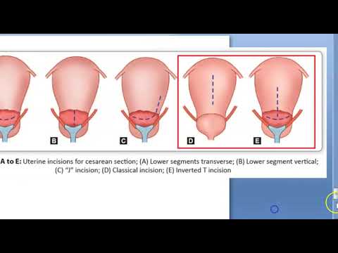 Obstetrics 692 Types of caesarean section csection LSCS Vs classical ...