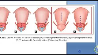 Obstetrics 692 Types of caesarean section csection LSCS Vs classical lower segment benefits when
