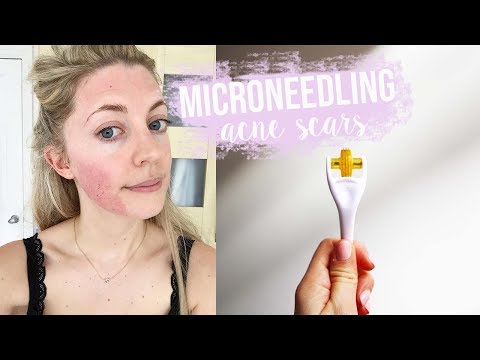 MICRONEEDLING HOME TUTORIAL: ACNE SCAR REMOVAL