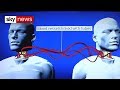 World's First Head Transplant: What's Involved?