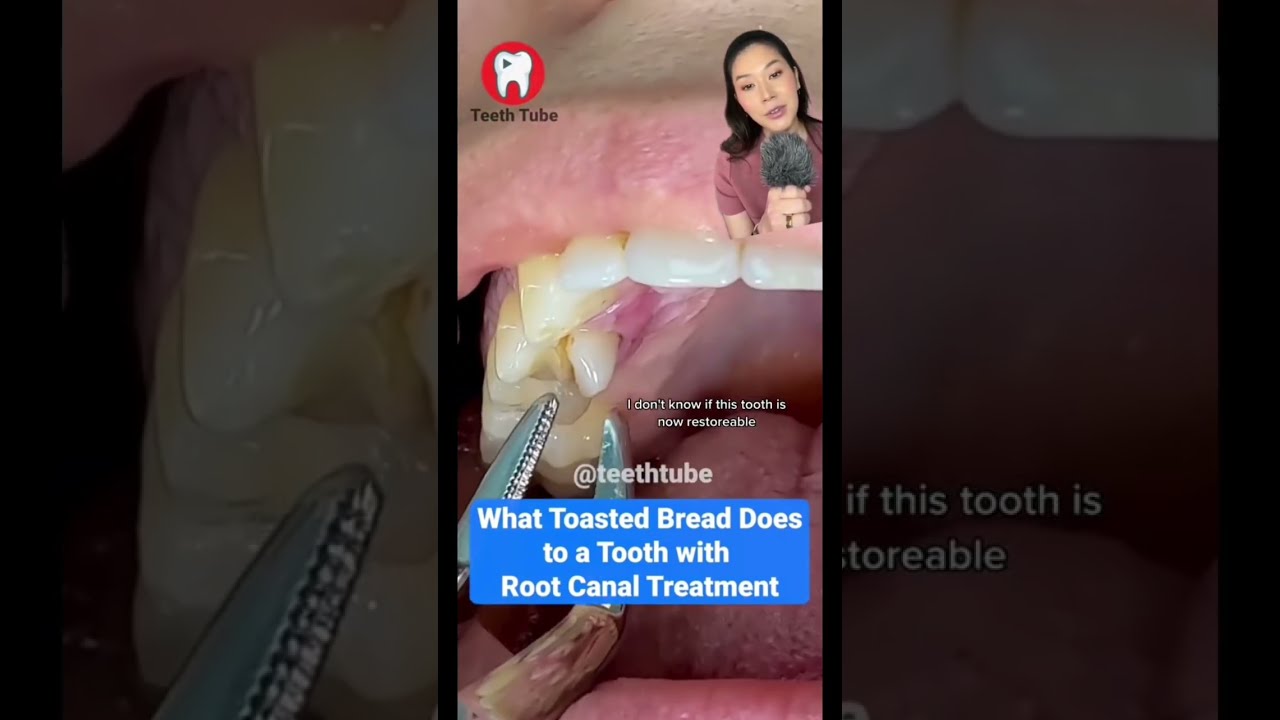 Cracked Tooth Cavity Rootcanal Dentist Dentistry Dentalvideo Teethwhitening