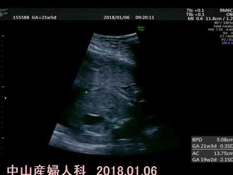 22週エコー動画女の子 Youtube
