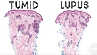 Tumid lupus erythematosus (pathology dermpath dermatology dermatopathology USMLE) screenshot 4