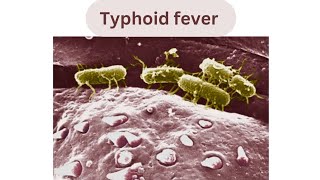 Uncovering Typhoid Fever: Understanding the Symptoms #shorts