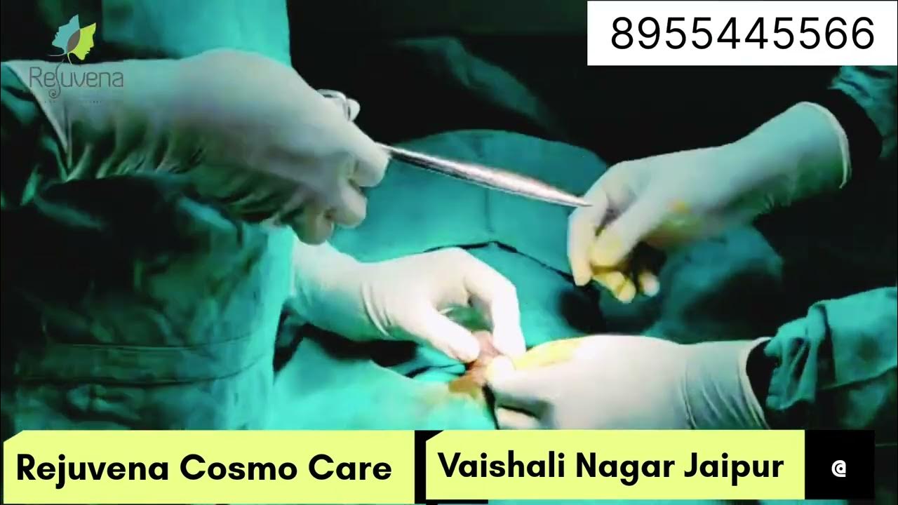 tight-frenulum-or-frenular-tear-repair-surgery-painless-frenuloplasty