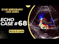 Echocardiography Case 68: Echo Spot Diagnosis Series | Echo Interpretation Made Easy