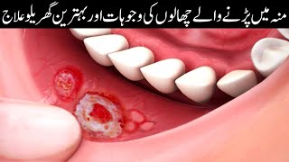 Munh K Chalon Ka Ilaj In Urduhindimouth Ulcers Causes & Treatment At Homemouth Blisters Treatment