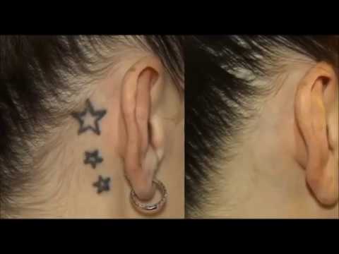 ტატუს მოშორება უკვალოდ