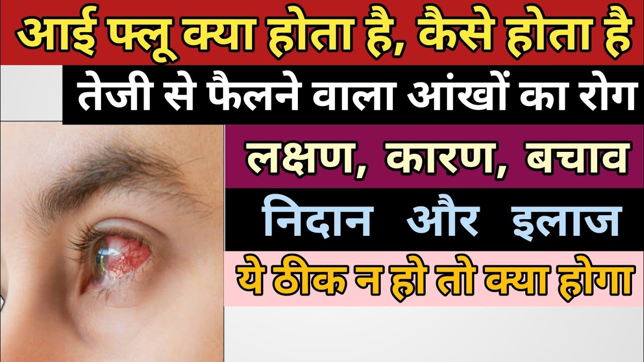 आई फ्लू के लक्षण, कारण और इलाज Eye flu hone par kya karen Eye flu