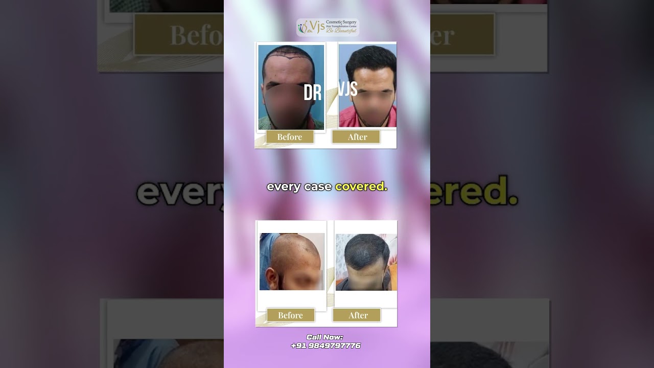 Hair Loss Not Waiting? | Hair Transplant Vizag | Can 40 Years of Expertise Really Restore Your Hair?