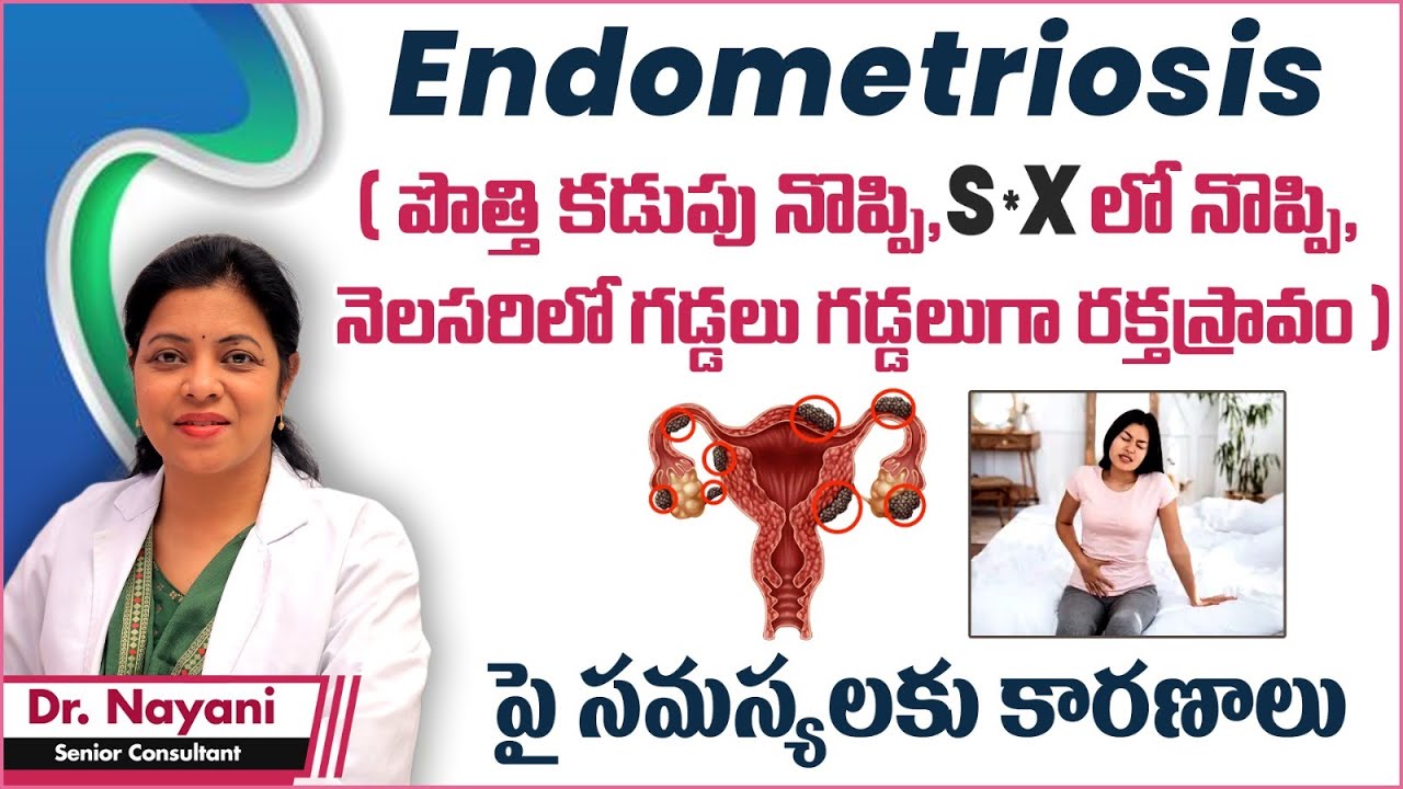 ఎండోమెట్రియోసిస్ కారణాలు || Causes of Endometriosis in Telugu || Best Fertility Center || Ferty9