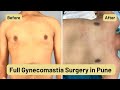 Best Gynecomastia Surgery in India | Dr. Salil Patil | Chrysalis Clinic Pune