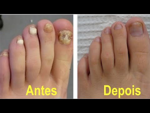 Vídeo: Unhas Grossas: Fotos, Causas E Tratamentos Caseiros