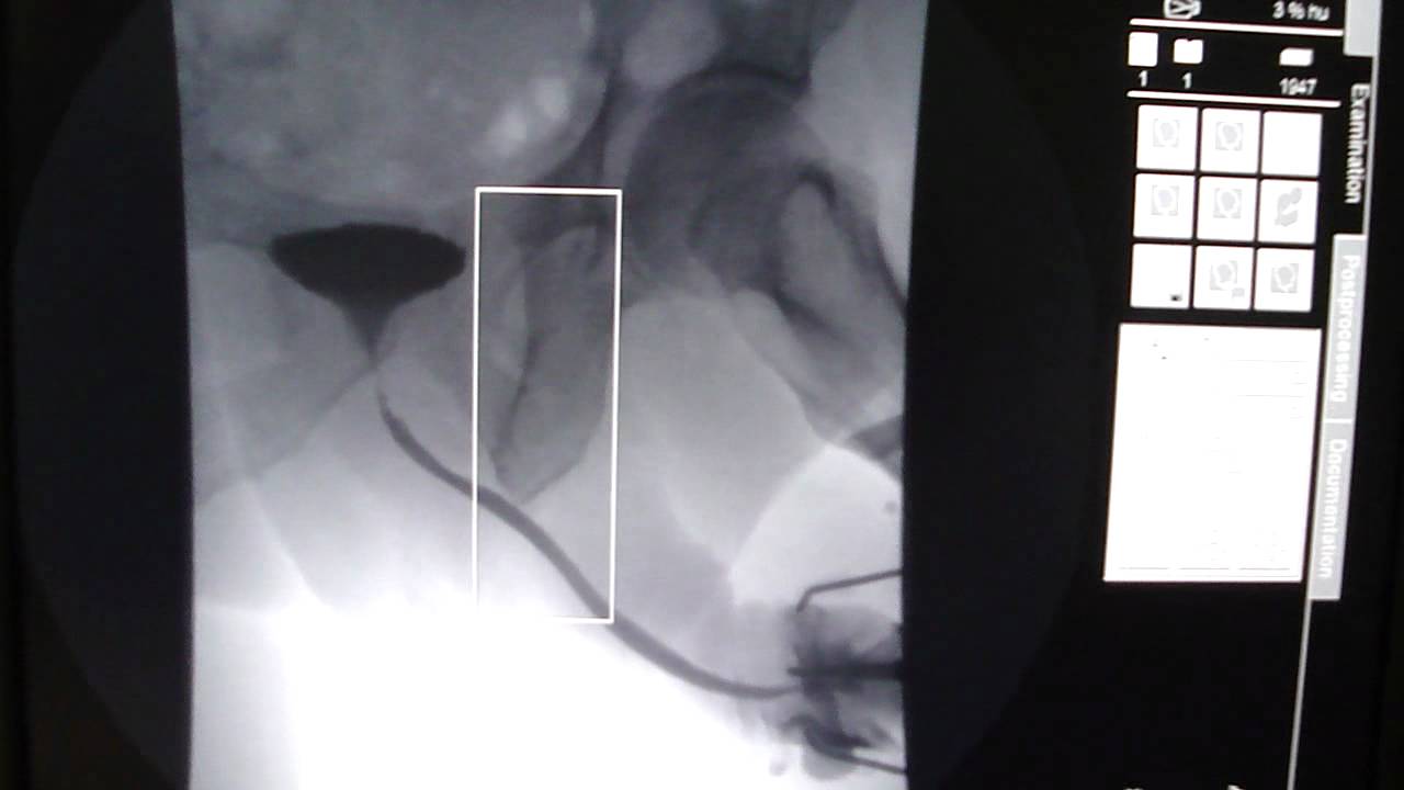 Uretrocistografia Retrogada Obliqua Esquerda.MP4 - YouTube