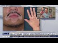 Health Watch: FDA approves first at-home vitiligo treatment