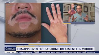 Health Watch: FDA approves first at-home vitiligo treatment screenshot 1